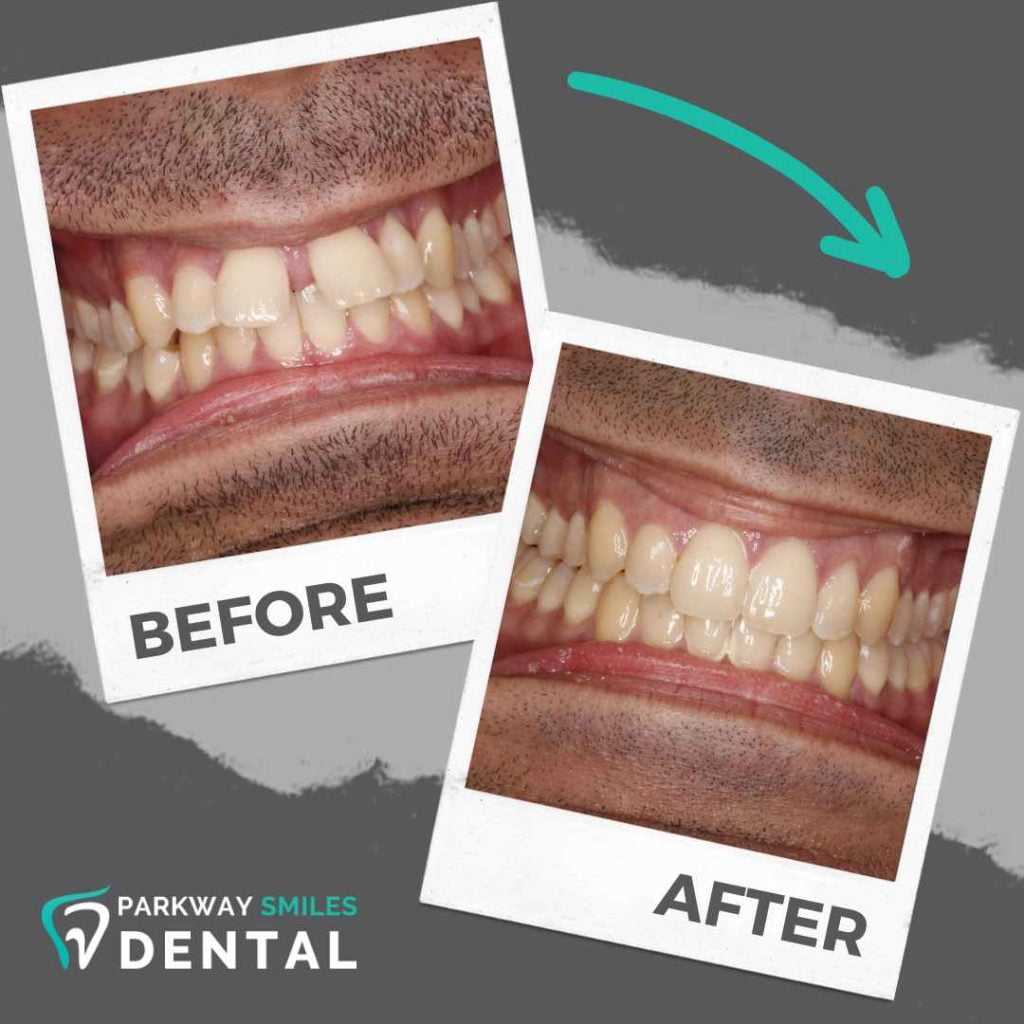 Before and After Parkway Smiles Orthodontics in Calgary 1