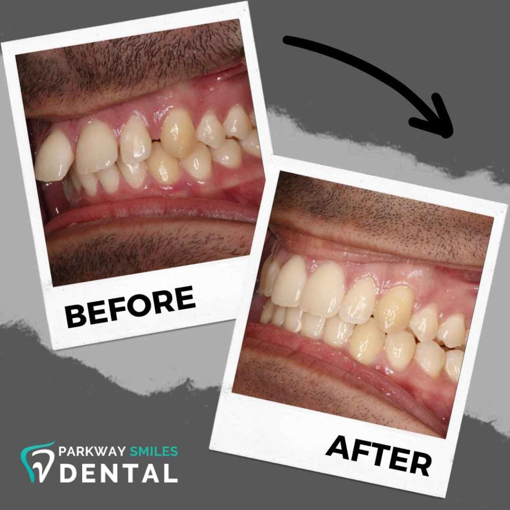 Before and After Parkway Smiles Orthodontics in Calgary 10