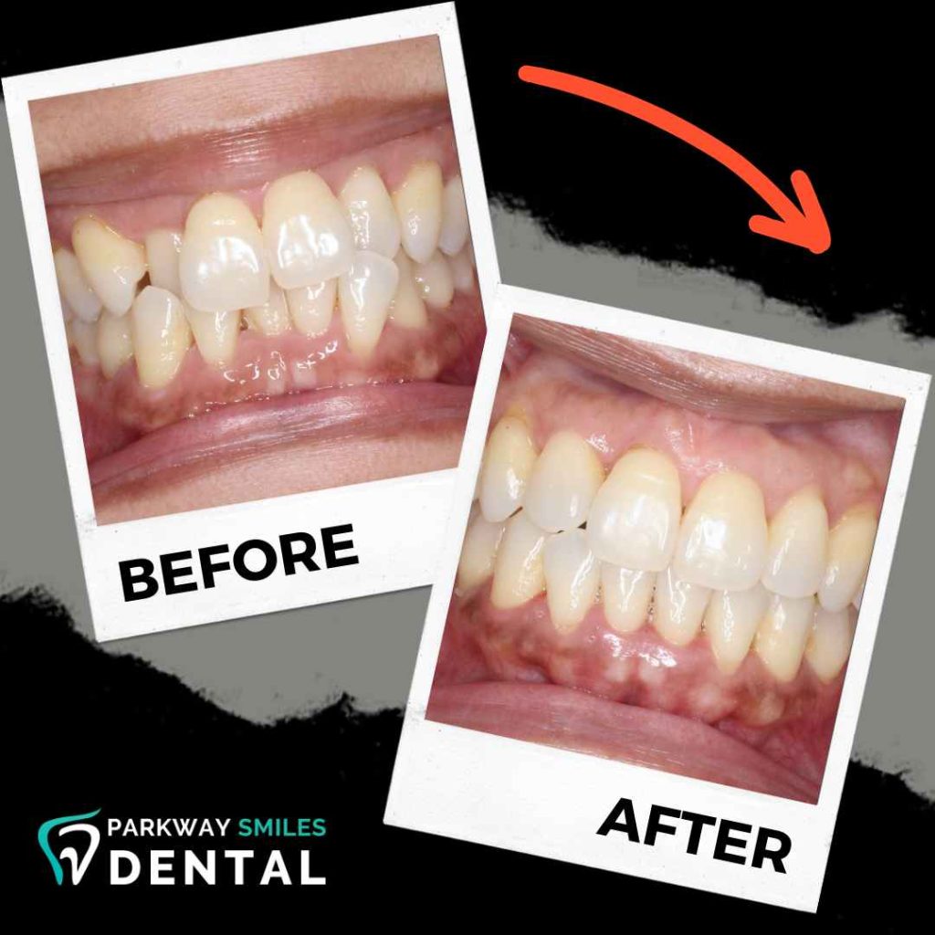 Before and After Parkway Smiles Orthodontics in Calgary 11