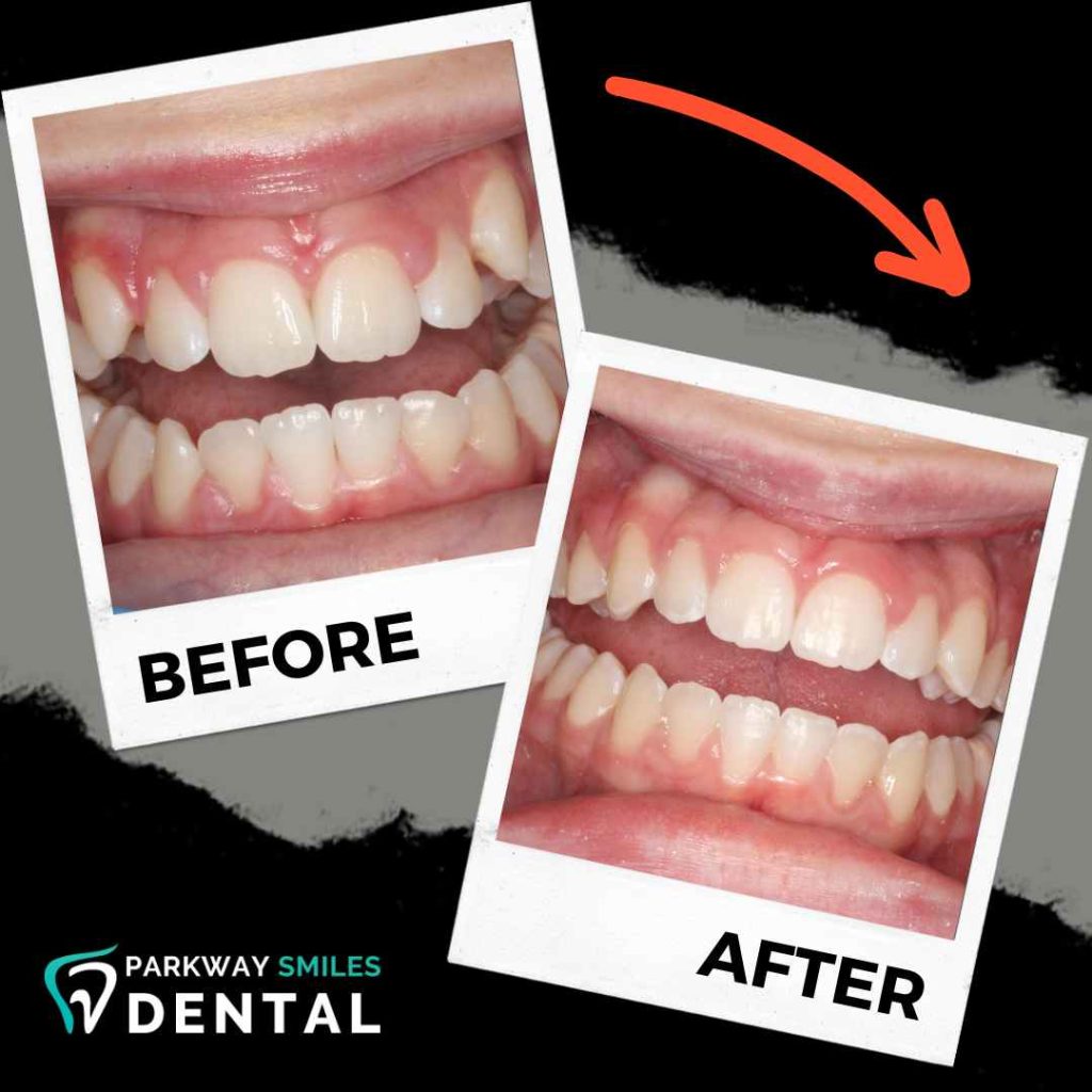 Before and After Parkway Smiles Orthodontics in Calgary 12
