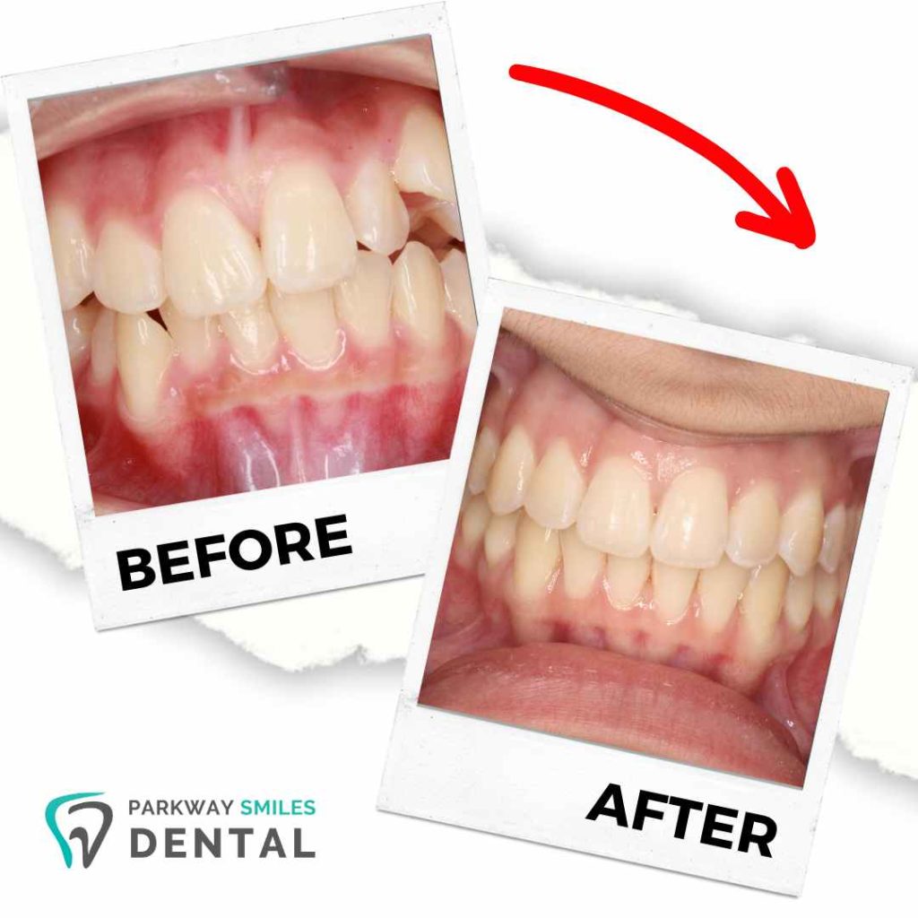 Before and After Parkway Smiles Orthodontics in Calgary 13