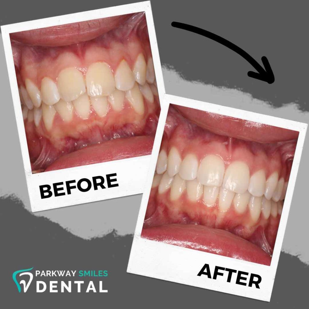 Before and After Parkway Smiles Orthodontics in Calgary 14