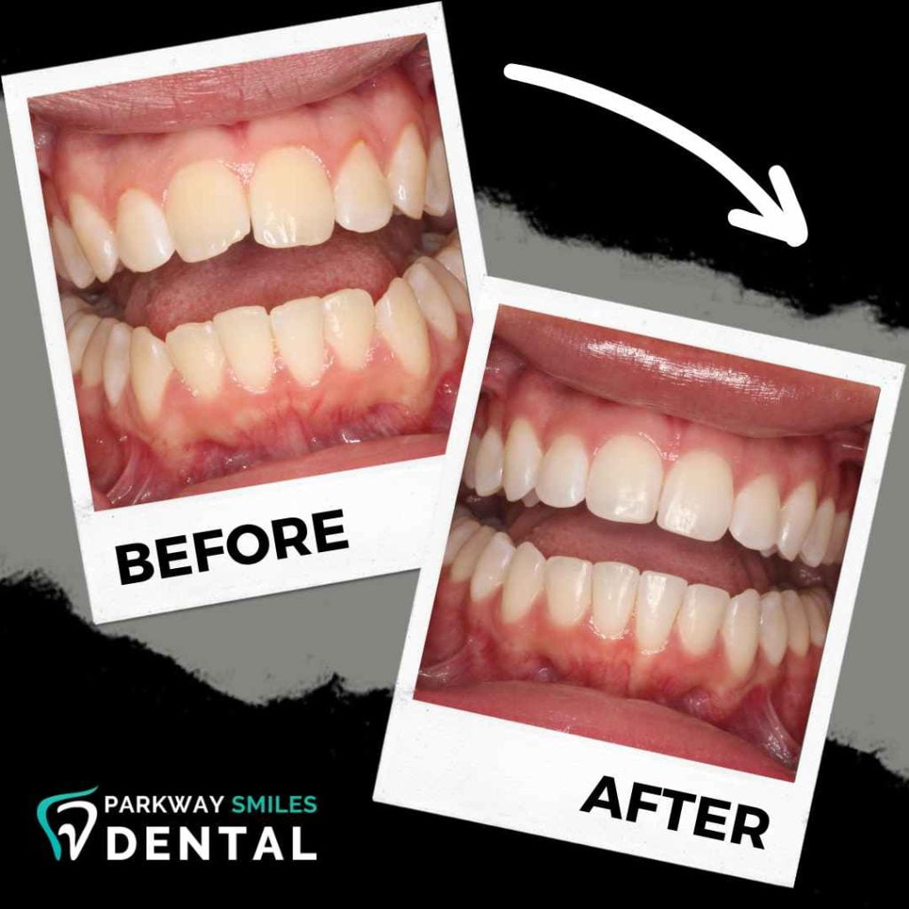 Before and After Parkway Smiles Orthodontics in Calgary 15