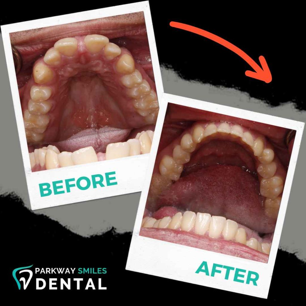 Before and After Parkway Smiles Orthodontics in Calgary 2