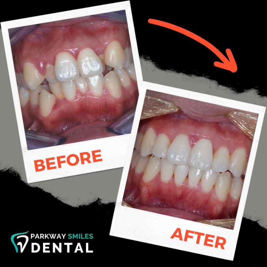 Before and After Parkway Smiles Orthodontics in Calgary 3