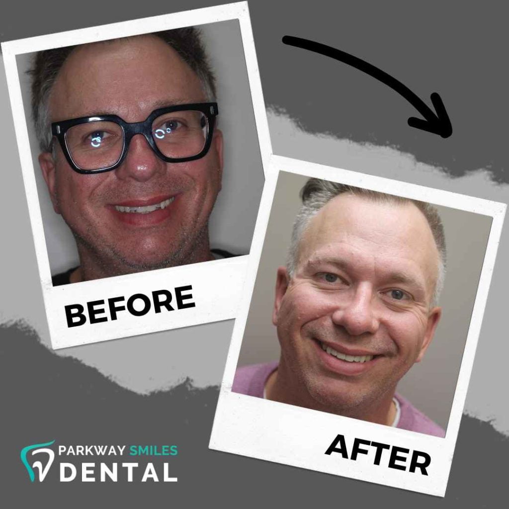 Before and After Parkway Smiles Orthodontics in Calgary 4