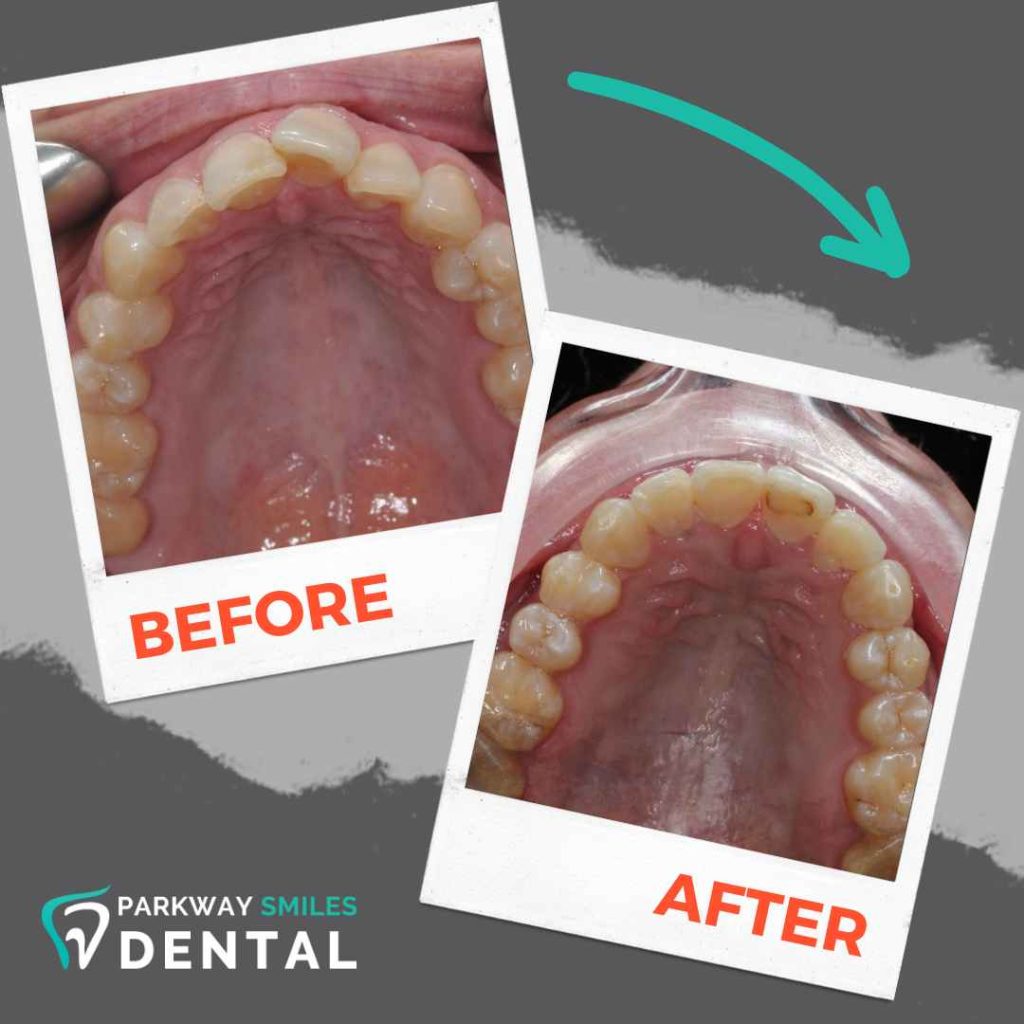 Before and After Parkway Smiles Orthodontics in Calgary 5