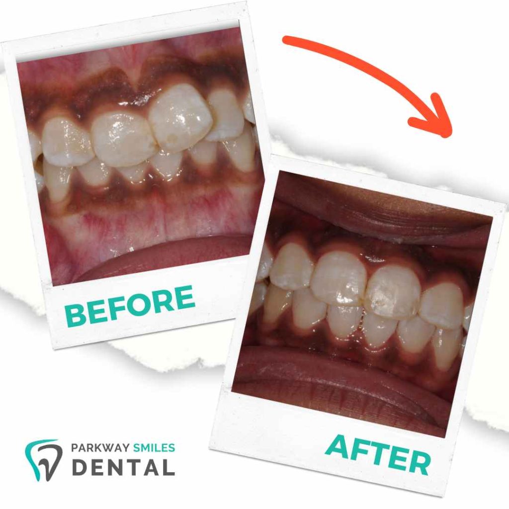 Before and After Parkway Smiles Orthodontics in Calgary 7
