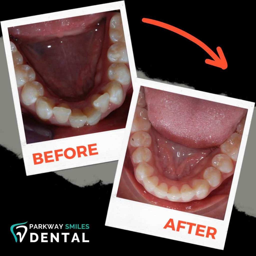 Before and After Parkway Smiles Orthodontics in Calgary 9